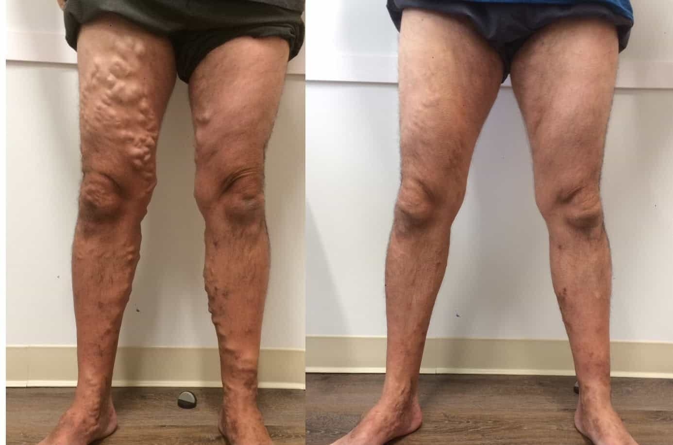 Risultato VENUSì vene varicose