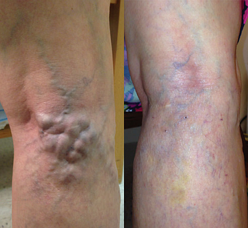 Risultato VENUSì gambe