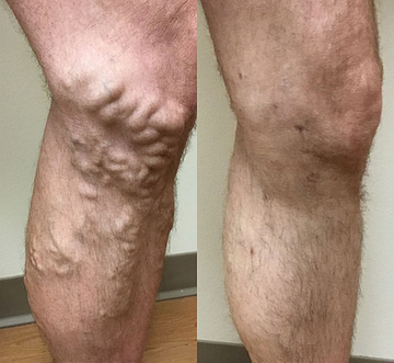 Risultato VENUSì gambe leggere