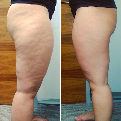 Risultati visibili cellulite rassodamento